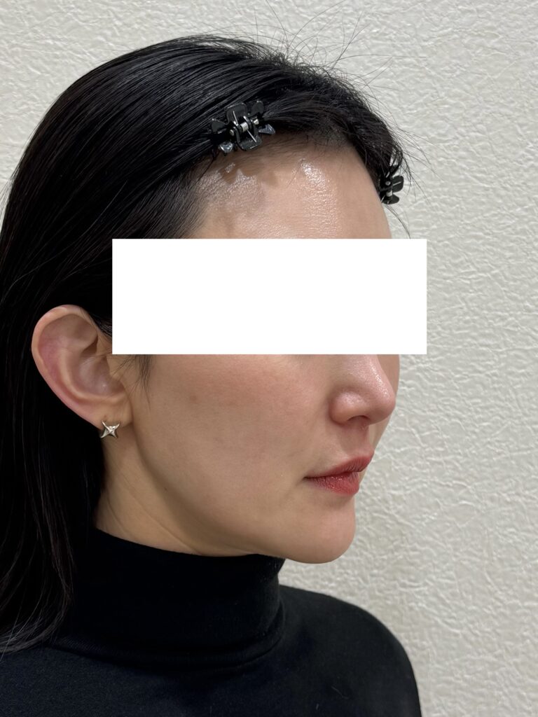 モフィウス 施術後