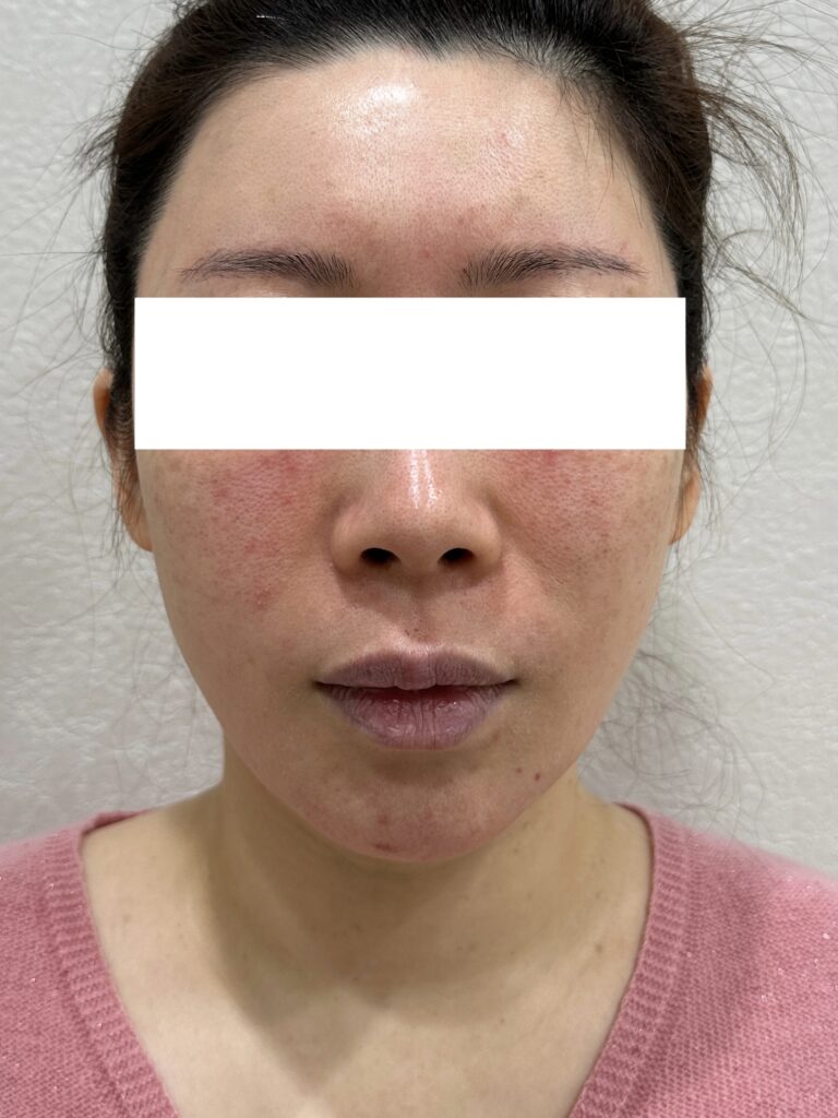 モフィウス 施術前