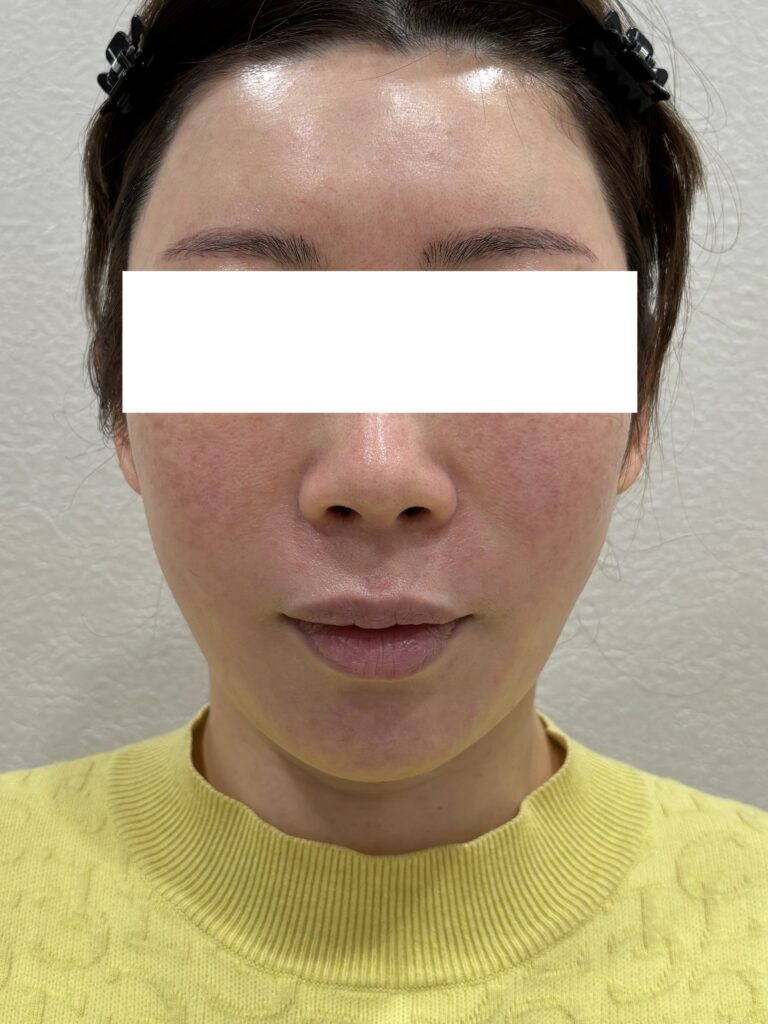 モフィウス 施術後