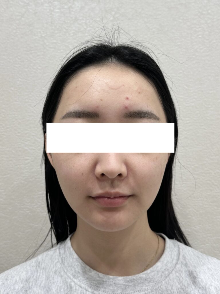 インモードリフト(20代女性) 施術前