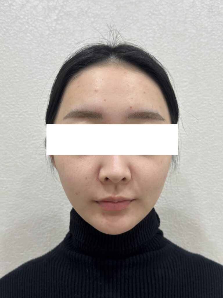 インモードリフト(20代女性) 施術後