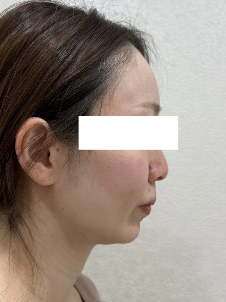 インモードリフト(30代女性) 施術前