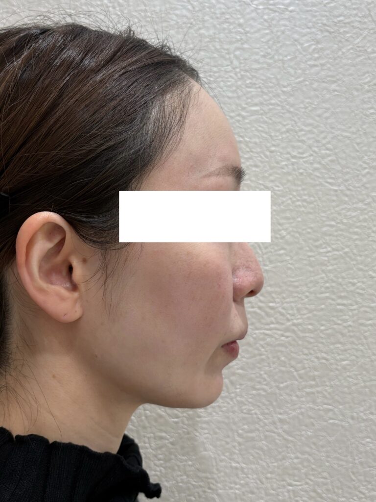インモードリフト(30代女性) 施術後