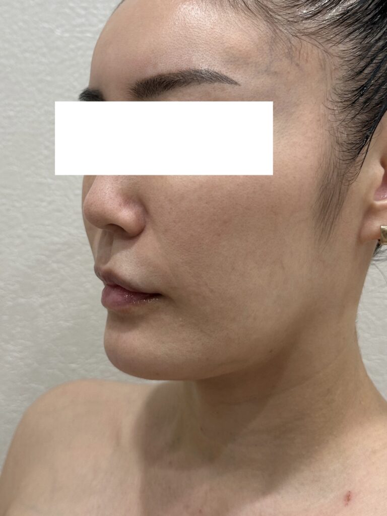 モフィウス 施術前
