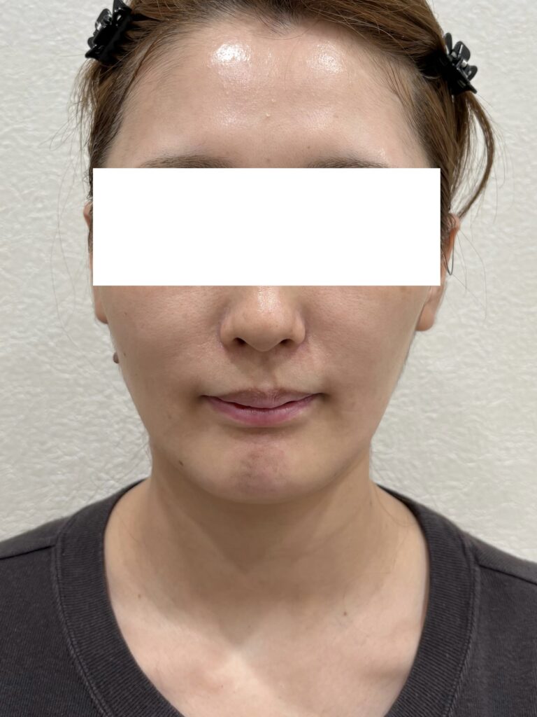 モフィウス 施術後
