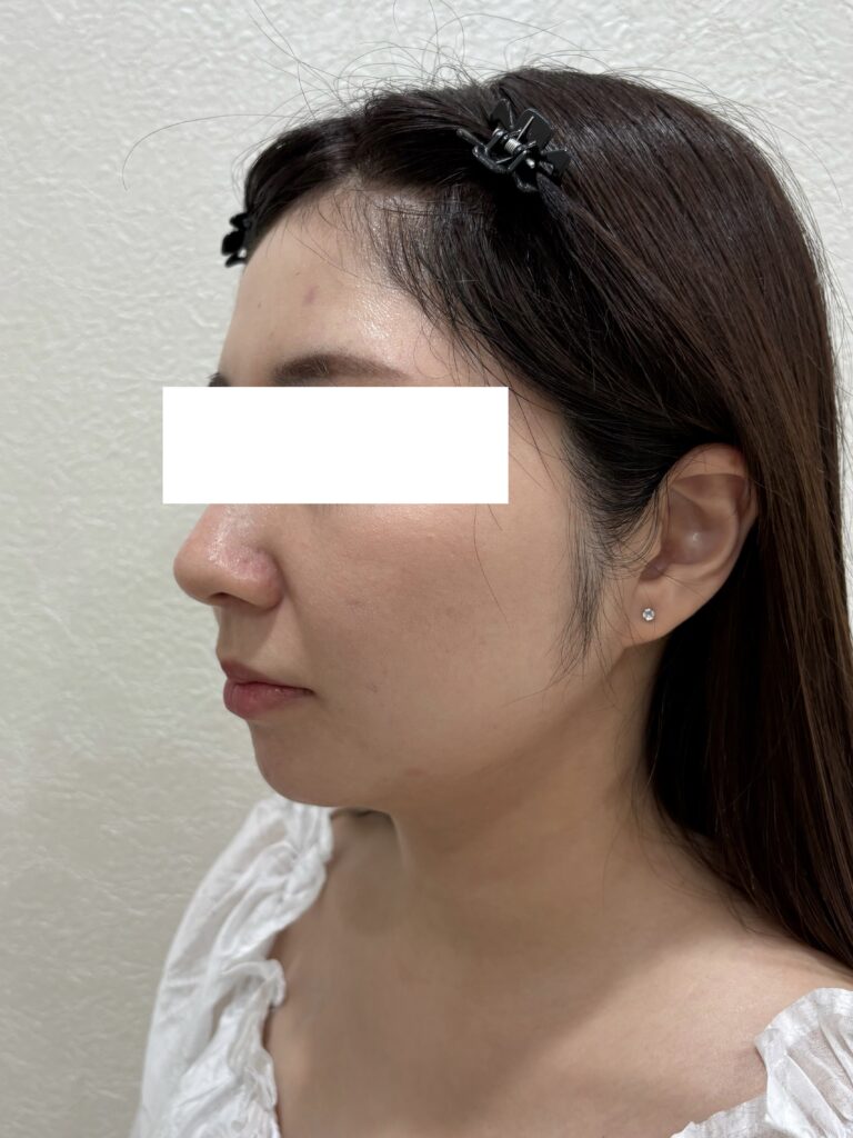 モフィウス8 施術後