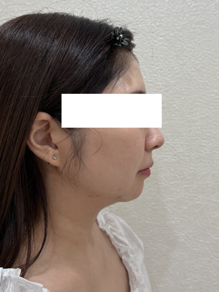 モフィウス8 施術後