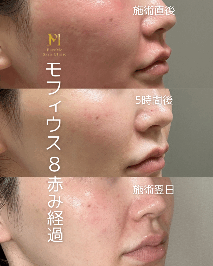 モフィウス8 ダウンタイム 施術前