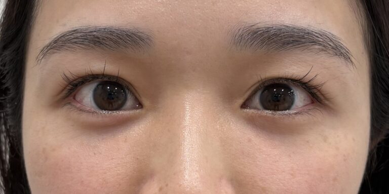 クマ取り＋エランセ注入 施術後